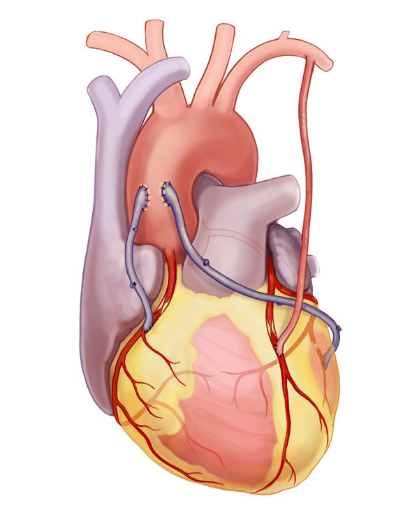 Bypass Surgery Prolonged Heart Health Avens Blog Avens Blog Bypass Surgery Prolonged Heart Health Avens Blog Avens Blog