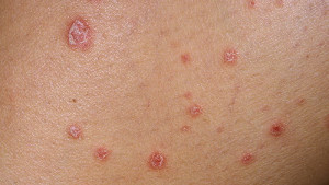 Psoriasis