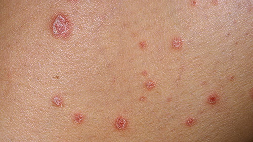 Scaly Skin Patches – Causes, Pictures, Treatment