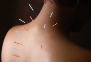 acupuncture_needles_in_womans_back