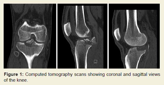 Avulsion fracture posterior tibial plateau