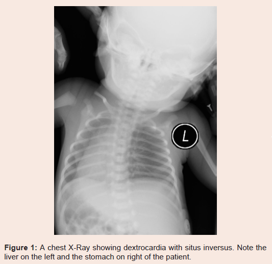 Avens Publishing Group - Dextrocardia with Situs Inversus, Atrio ...