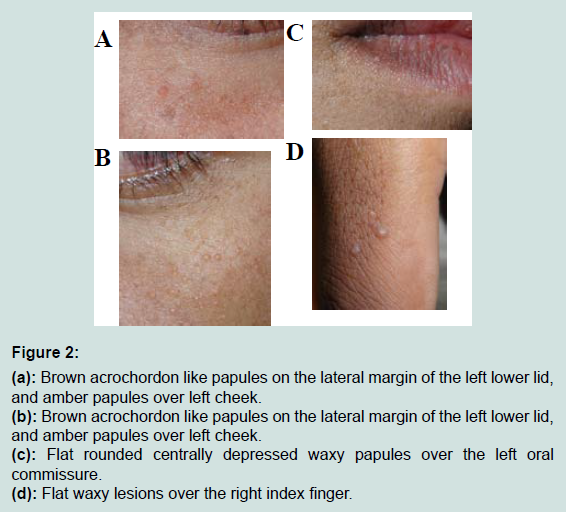 Avens Publishing Group A Case Of Juvenile Colloid Milium With