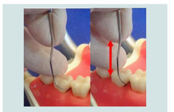 Avens Publishing Group Comparative In Vitro Performance Of An Odu 11 12 Dental Explorer And Differential Reflectometry For Detection Of Subgingival Dental Calculus